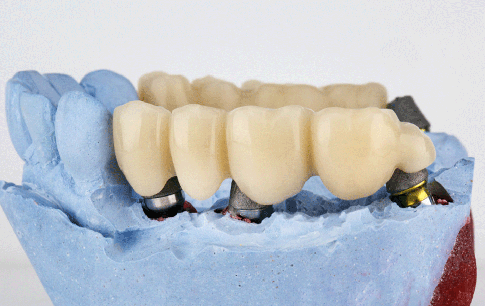 Jaw mold showing a dental bridge of four implants.