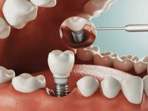 Digital rendering of a dental implant being placed in the socket.