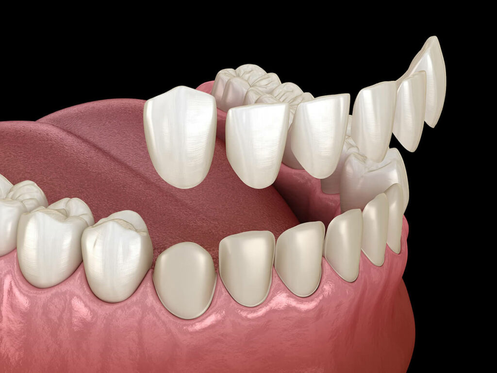 Digital rendering of veneers being placed over natural teeth.