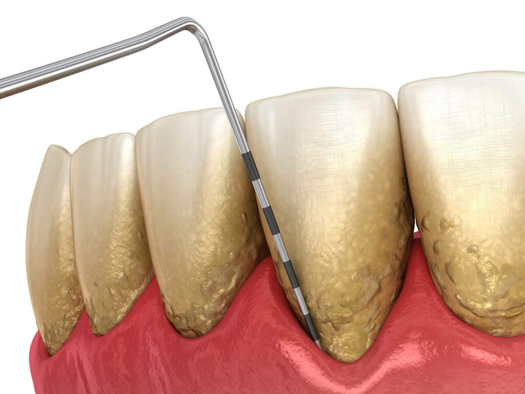 Digital rendering of teeth with serve plaque build up.