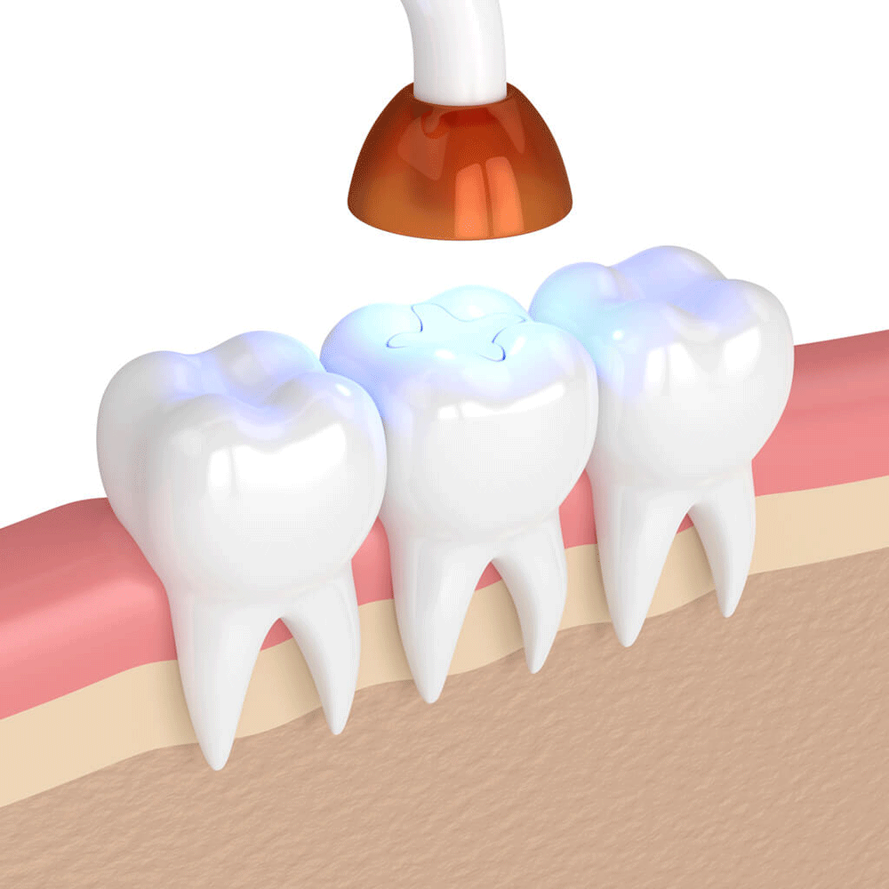 Digital rendering of a filling being sealed onto a tooth.