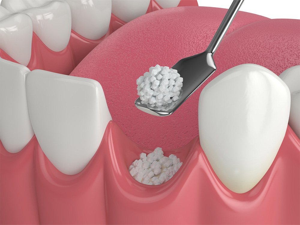 A close-up view of a dental procedure with granular material being placed into a gap between teeth using a dental tool, likely a bone graft to support oral health.