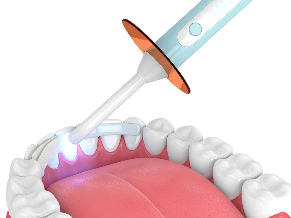 Digital rendering of a dental bonding procedure.