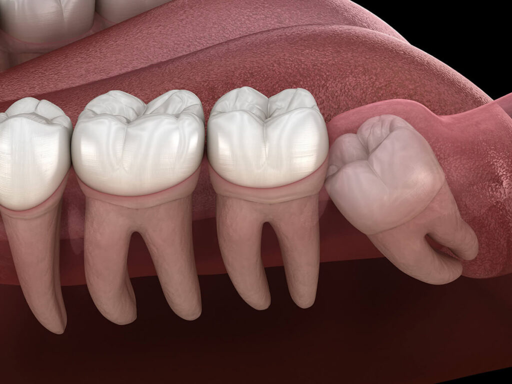 Digital rendering of an impacted wisdom tooth pushing against other teeth in the mouth.