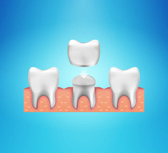 Illustration of a same-day crown procedure at Grandview Dental Care, showing prepared tooth and crown placement.