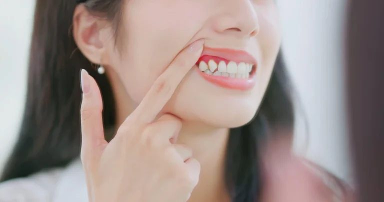Woman pointing at her gums while smiling, highlighting healthy teeth and awareness of gum disease prevention.